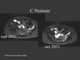 C.Noémie

sept 2011

oct 2011
infectious Sacroiliitis staph

 