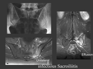 Effusion
Unilateral

infectious Sacroiliitis

 