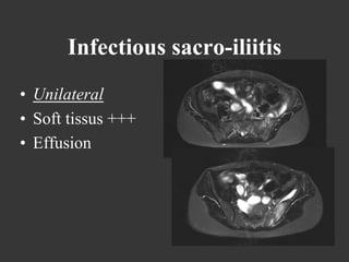 Infectious sacro-iliitis
•  Unilateral
•  Soft tissus +++
•  Effusion

 