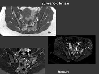 26 year-old female

fracture

 