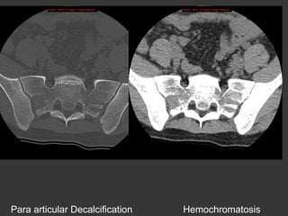 Para articular Decalcification

Hemochromatosis

 