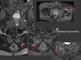 bilateral sacroiliitis

 