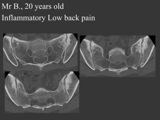 Mr B., 20 years old
Inflammatory Low back pain

 