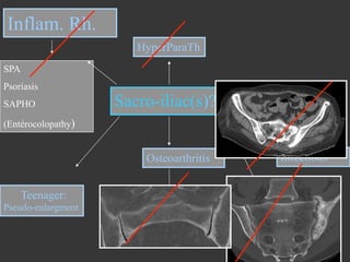 Inflam. Rh.
HyperParaTh
SPA
Psoriasis
SAPHO

Sacro-iliac(s)?

(Entérocolopathy)

Osteoarthritis

Infectious

Teenager:
Pseudo-enlargment

Para articular bone

 
