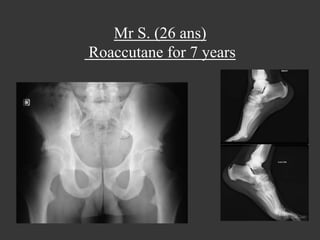 Mr S. (26 ans)
Roaccutane for 7 years

 