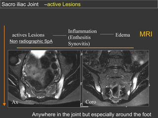 Sacro iliac Joint

–active Lesions

Non radiographic SpA

Edema

Destruction

actives Lesions

Inflammation
(Enthesitis
Synovitis)

Erosions

chronic Lesions

Sclerosis
Repair

Ax

MRI

Syndesmophyts

Xrays, CT, MRI

Coro
ankylosing Spondylarthritis

Ankylosis

Anywhere in the joint but especially around the foot

 