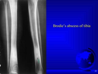 Tibia Abscess Msk Lecture3 1st Hospital | PPT