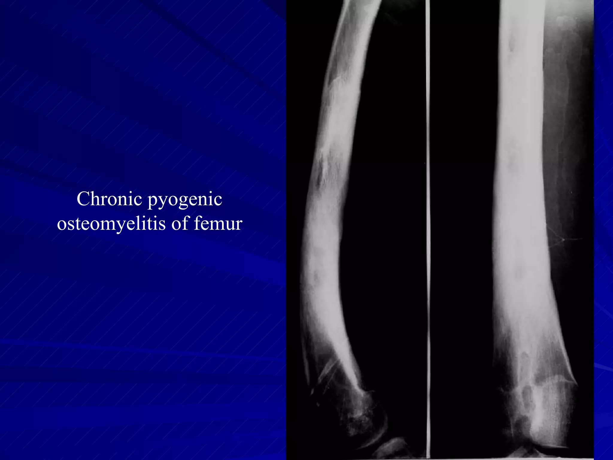 Chronic pyogenic osteomyelitis of femur