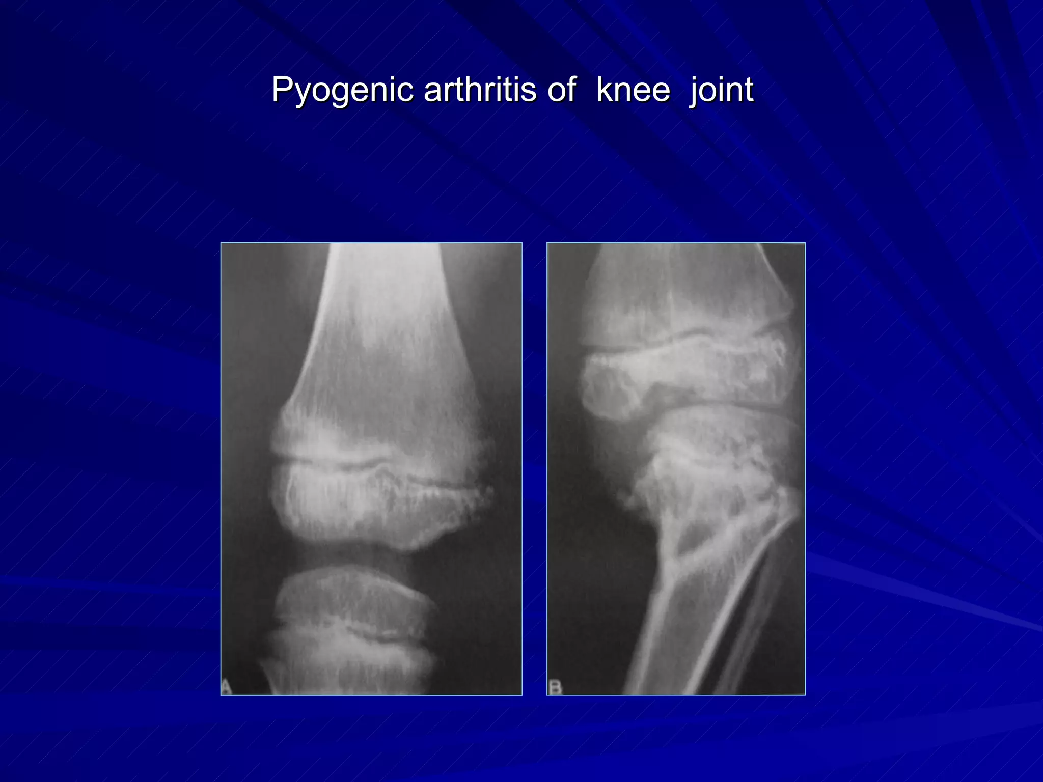 Pyogenic arthritis of knee joint