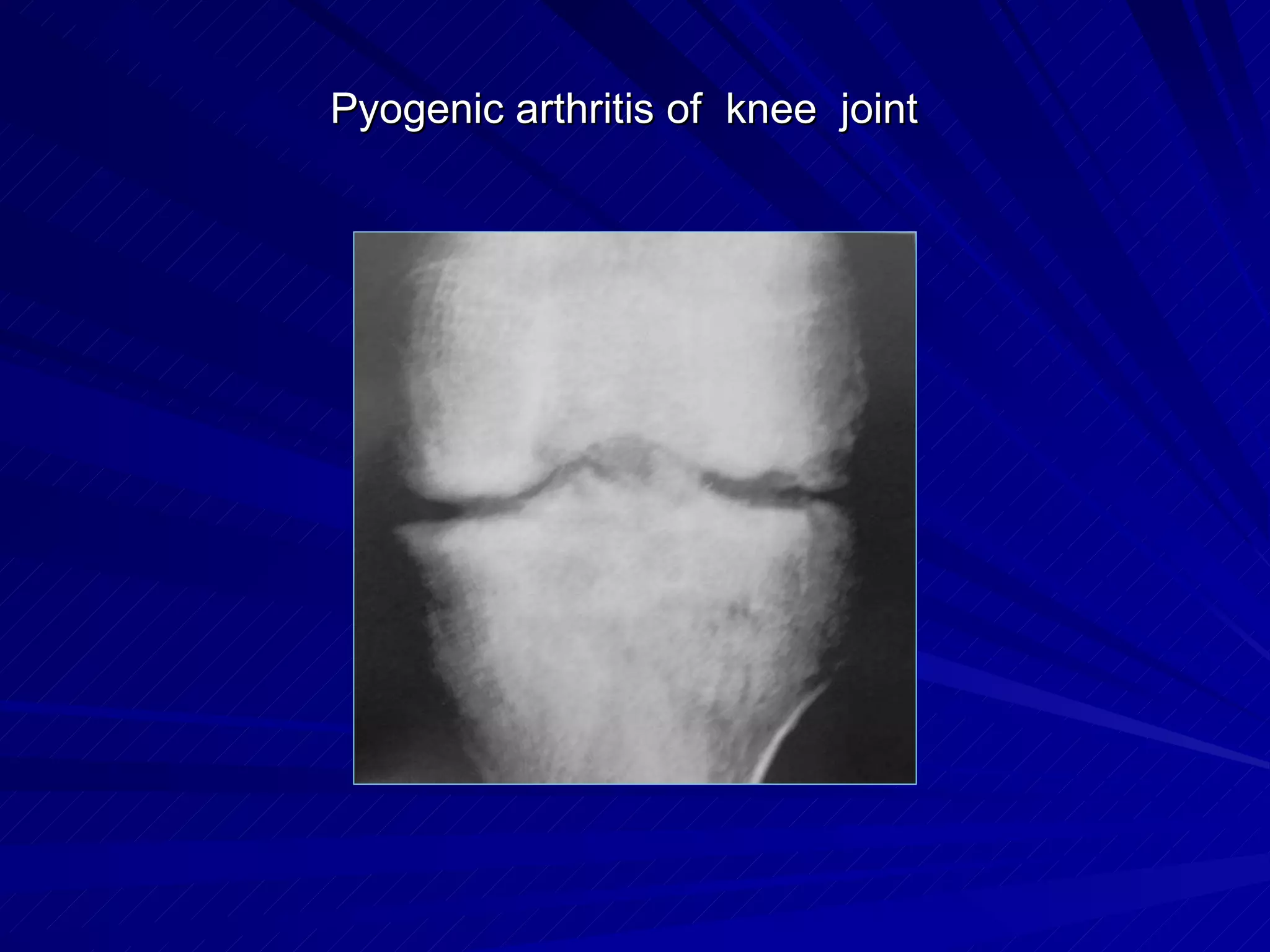Pyogenic arthritis of knee joint