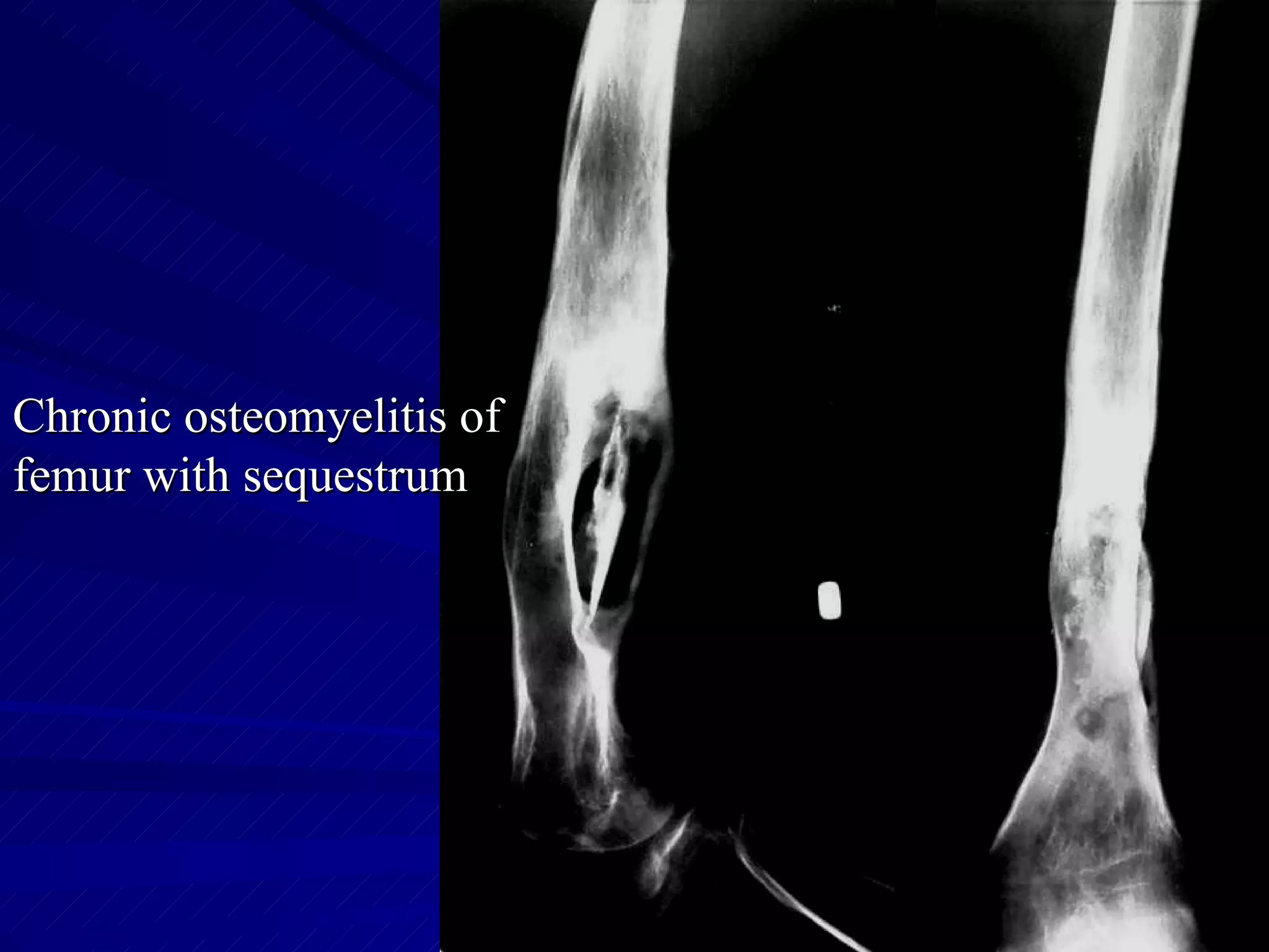Chronic osteomyelitis of femur with sequestrum