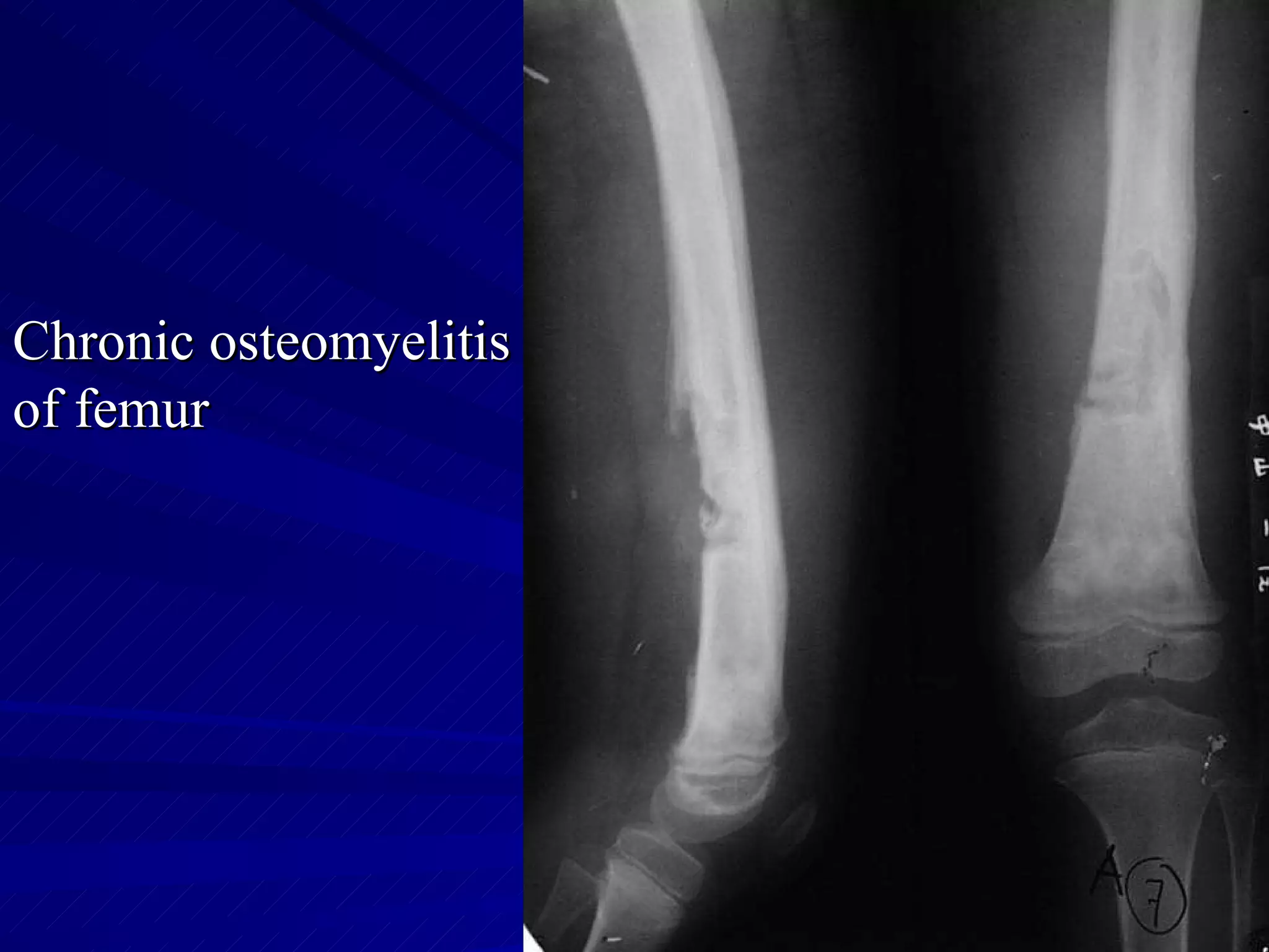 Chronic osteomyelitis of femur