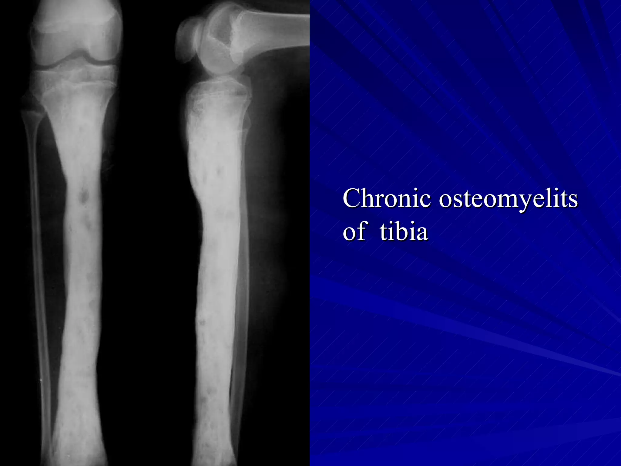 Chronic osteomyelits of tibia