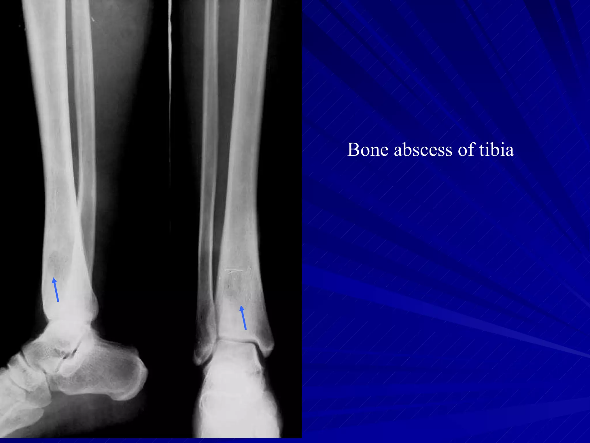 Bone abscess of tibia