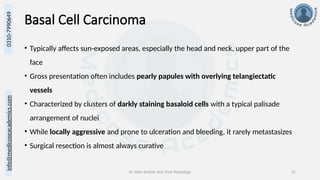 Dr. Sidra Arshad, Asst. Prof. Physiology 21
0310-7990649
info@medicoseacademics.com
Basal Cell Carcinoma
• Typically affects sun-exposed areas, especially the head and neck, upper part of the
face
• Gross presentation often includes pearly papules with overlying telangiectatic
vessels
• Characterized by clusters of darkly staining basaloid cells with a typical palisade
arrangement of nuclei
• While locally aggressive and prone to ulceration and bleeding, it rarely metastasizes
• Surgical resection is almost always curative
 