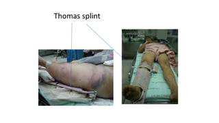 Thomas Splint Labelled MSK INJURY Bsc,Nurse_121638.ppt for nurses | PPTX
