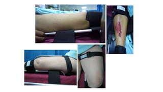 Msk Injuries Kit MSK INJURY Bsc,Nurse_121638.ppt for nurses | PPTX