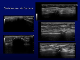 Msk need to know ultrasound lumps & bumps & various joints | PDF