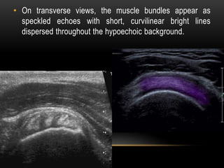 • On transverse views, the muscle bundles appear as
speckled echoes with short, curvilinear bright lines
dispersed throughout the hypoechoic background.
 