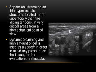 • Appear on ultrasound as
thin hyper echoic
structures located more
superficially than the
sliding tendons, in very
critical areas from a
biomechanical point of
view.
• Dynamic Scanning and
high amount of gel is
used as a spacer in order
to avoid any pressure on
the tissue, for the
evaluation of retinacula.
 