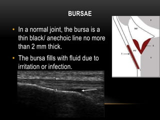 BURSAE
• In a normal joint, the bursa is a
thin black/ anechoic line no more
than 2 mm thick.
• The bursa fills with fluid due to
irritation or infection.
 
