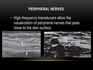 PERIPHERAL NERVES
• High-frequency transducers allow the
visualization of peripheral nerves that pass
close to the skin surface.
 