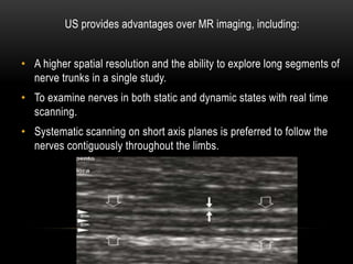 US provides advantages over MR imaging, including:
• A higher spatial resolution and the ability to explore long segments of
nerve trunks in a single study.
• To examine nerves in both static and dynamic states with real time
scanning.
• Systematic scanning on short axis planes is preferred to follow the
nerves contiguously throughout the limbs.
 