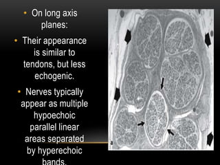 • On long axis
planes:
• Their appearance
is similar to
tendons, but less
echogenic.
• Nerves typically
appear as multiple
hypoechoic
parallel linear
areas separated
by hyperechoic
 