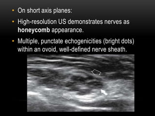 • On short axis planes:
• High-resolution US demonstrates nerves as
honeycomb appearance.
• Multiple, punctate echogenicities (bright dots)
within an ovoid, well-defined nerve sheath.
 