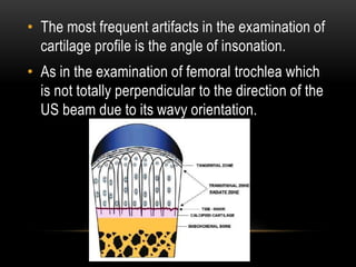 • The most frequent artifacts in the examination of
cartilage profile is the angle of insonation.
• As in the examination of femoral trochlea which
is not totally perpendicular to the direction of the
US beam due to its wavy orientation.
 