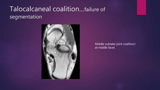 Talocalcaneal coalition…failure of
segmentation
Middle subtalar joint coalition/
at middle facet.
 