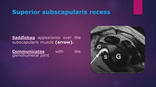 Saddlebag appearance over the
subscapularis muscle (arrow).
Communicates with the
glenohumeral joint
Superior subscapularis recess
 