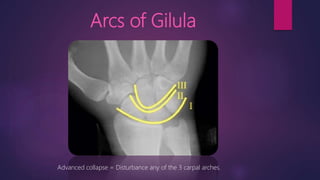 Arcs of Gilula
Advanced collapse = Disturbance any of the 3 carpal arches.
 