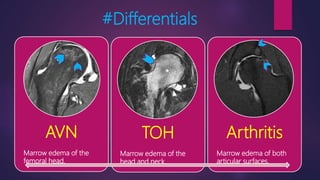 #Differentials
AVN
Marrow edema of the
femoral head.
TOH
Marrow edema of the
head and neck.
Arthritis
Marrow edema of both
articular surfaces.
 