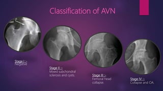 Stage I :-
Negative
Stage II :-
Mixed subchondral
sclerosis and cysts. Stage III :-
Femoral head
collapse.
Stage IV :-
Collapse and OA.
Classification of AVN
 