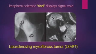 Peripheral sclerotic “rind” displays signal void.
Liposclerosing myxofibrous tumor (LSMFT)
 