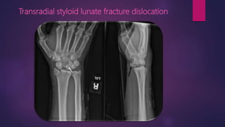Transradial styloid lunate fracture dislocation
 