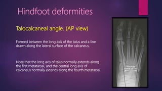 Hindfoot deformities
Talocalcaneal angle. (AP view)
Formed between the long axis of the talus and a line
drawn along the lateral surface of the calcaneus,
Note that the long axis of talus normally extends along
the first metatarsal, and the central long axis of
calcaneus normally extends along the fourth metatarsal.
 