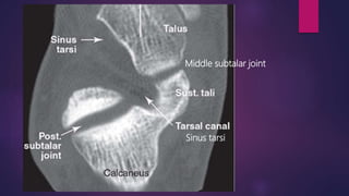 Sinus tarsi
Middle subtalar joint
 