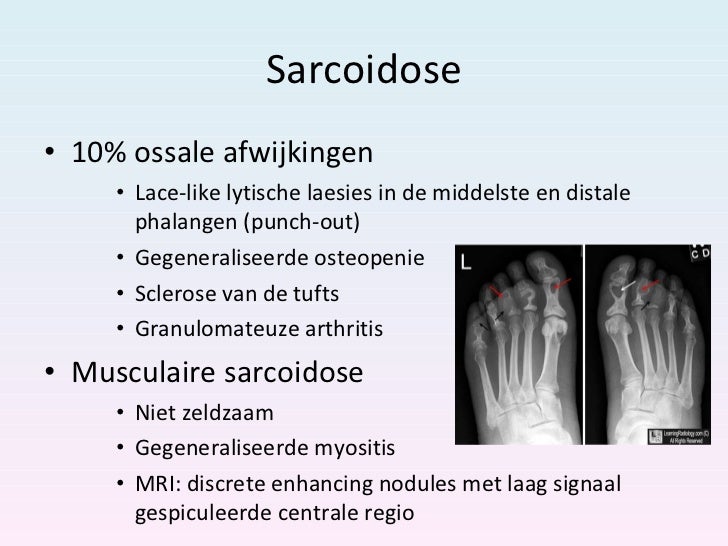 ossale afwijkingen