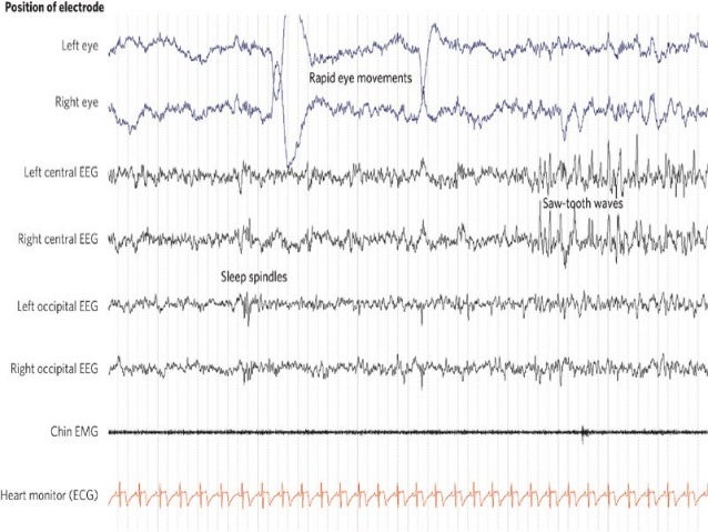 Multiple Sleep Latency Test Mslt And Maintenance Of Wakefulness Tes Multiple Sleep Latency Test Mslt And Maintenance Of Wakefulness Tes