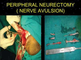PERIPHERAL NEURECTOMY
( NERVE AVULSION)
 