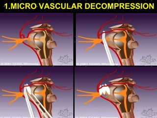 1.MICRO VASCULAR DECOMPRESSION
 