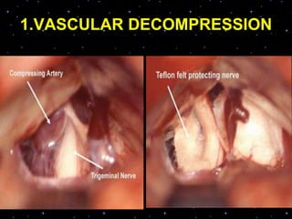 1.VASCULAR DECOMPRESSION
 
