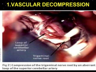 1.VASCULAR DECOMPRESSION
 
