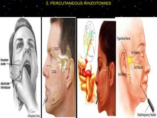 2. PERCUTANEOUS RHIZOTOMIES
 