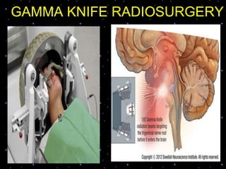 GAMMA KNIFE RADIOSURGERY
 