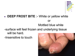 ● DEEP FROST BITE :- White or yellow white
or
Mottled blue white
-surface will feel frozen and underlying tissue
will be hard.
-Insensitive to touch
 
