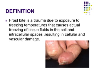 DEFINITION
● Frost bite is a trauma due to exposure to
freezing temperatures that causes actual
freezing of tissue fluids in the cell and
intracellular spaces ,resulting in cellular and
vascular damage.
 