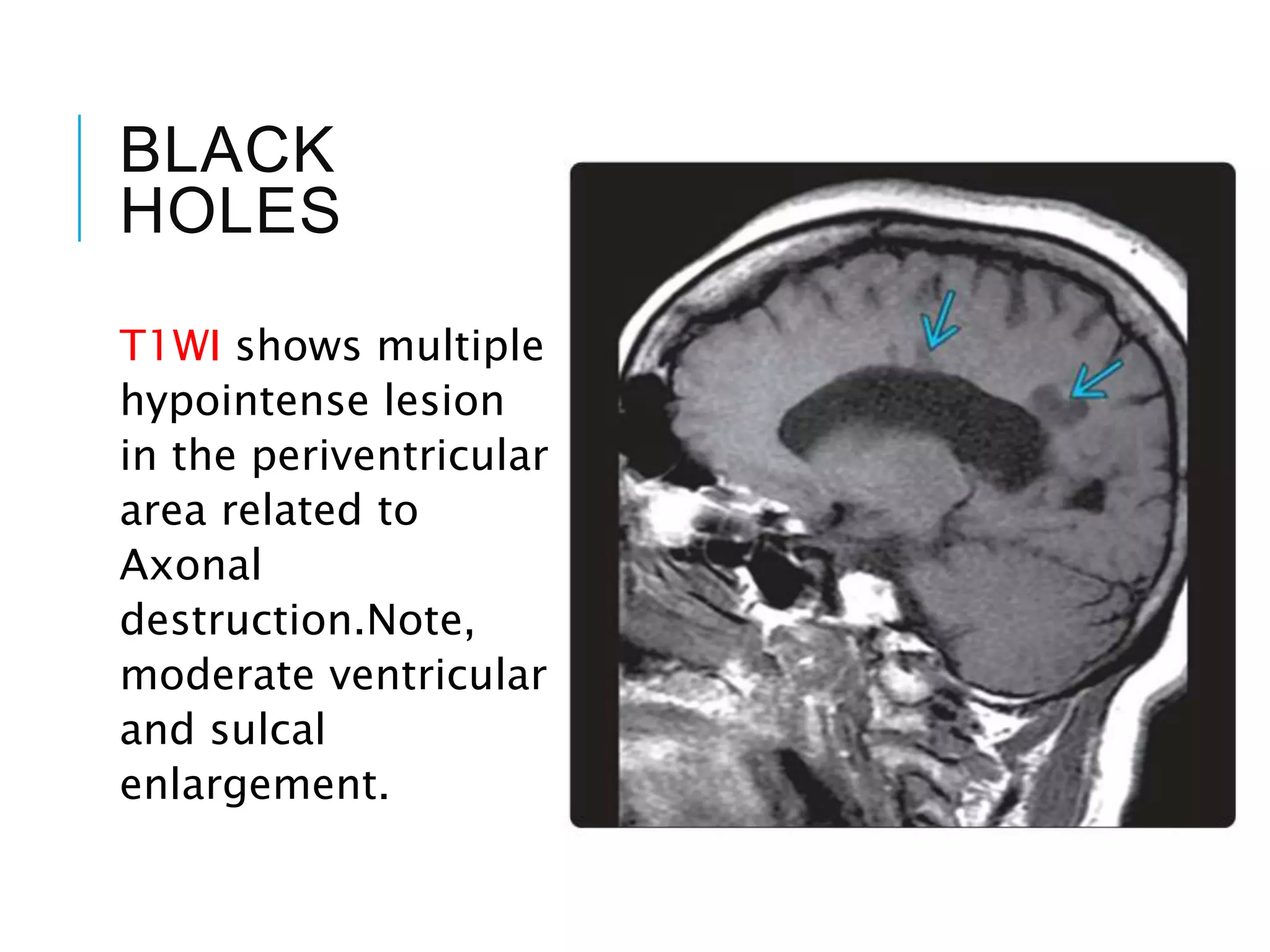BLACK
HOLES
T1WI shows multiple
hypointense lesion
in the periventricular
area related to
Axonal
destruction.Note,
moderate ventricular
and sulcal
enlargement.
 